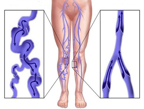 Comparison of the veins affected by cancer and veins after using venisels