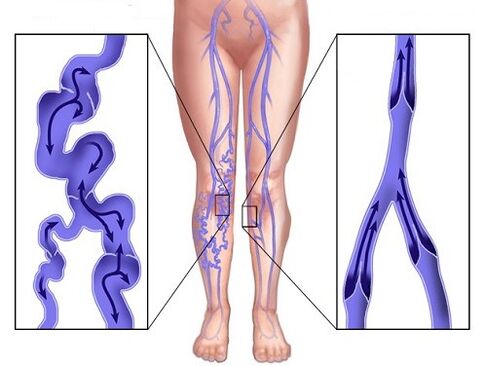 Comparison of veins that are affected by varicose and veins after using zxcvbnmq value