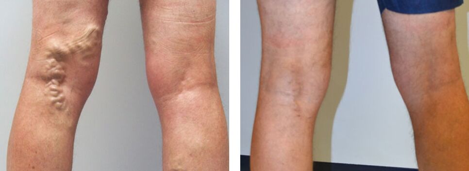 Photo before and after using Veniselle, experience in the use of cream