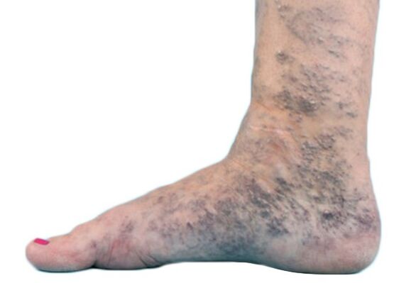 Varicose veins on the legs
