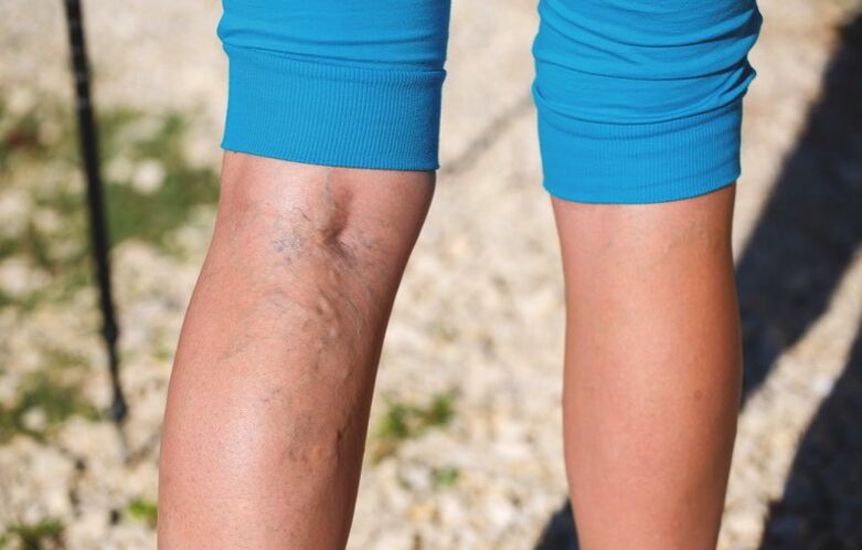 Damage to the lower extremities