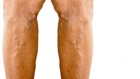 Visible manifestations of varicose veins on the legs