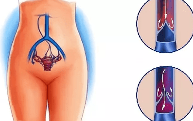 The reasons for the development of varicose veins of the pelvis