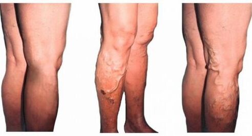 Causes of varicose veins