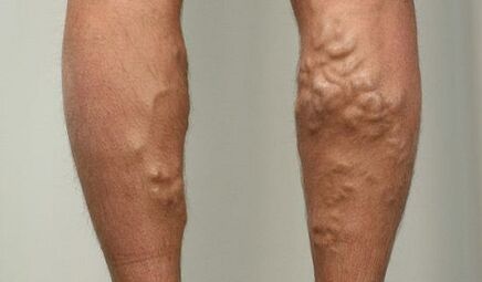 Symptoms of varicose veins