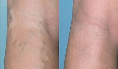 How to treat varicose veins on the legs