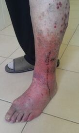 Leg affected with varicose veins after hirudotherapy