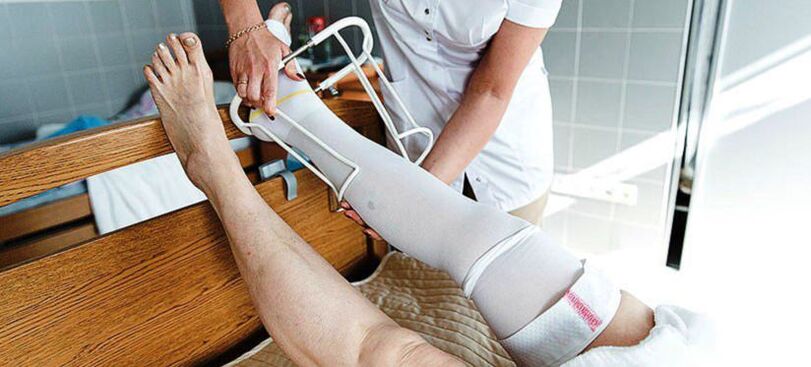 Compression stockings for the treatment of varicose veins