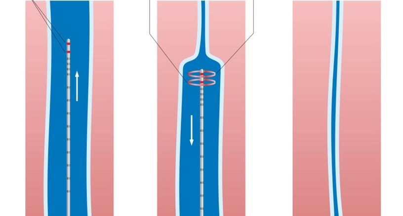 Laser treatment of varicose veins on the legs