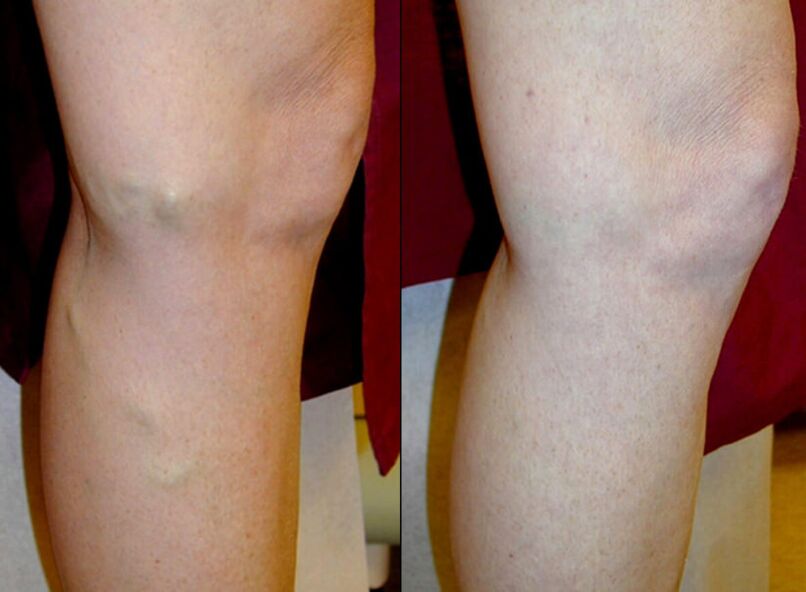 Methods for treating varicose veins on the legs