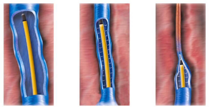 Radiofrequency ablation as a method for treating varicose veins