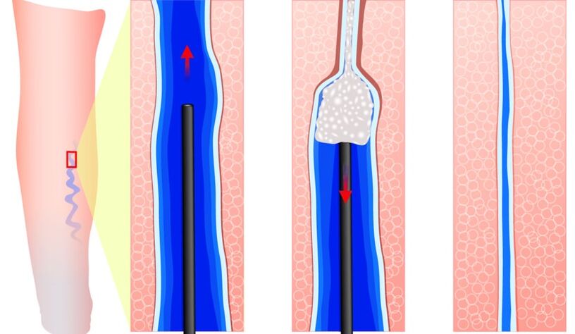 Sclerotherapy as a method for treating varicose veins