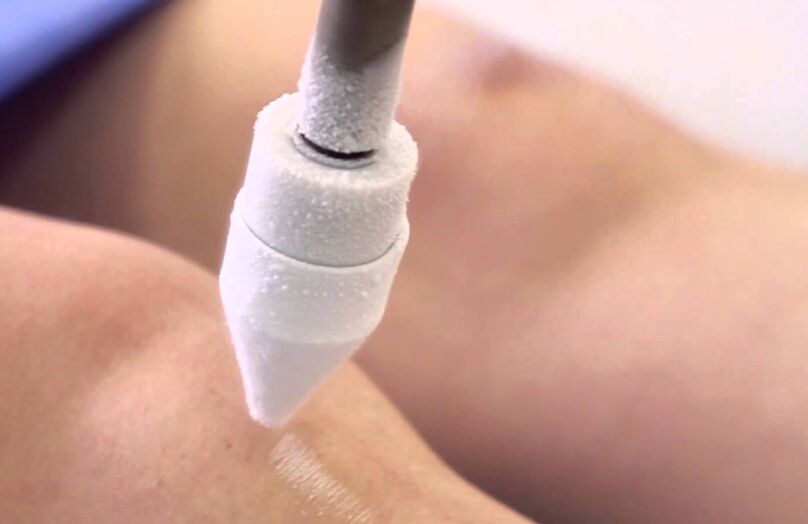 Treatment of varicose veins on the legs with cryotherapy