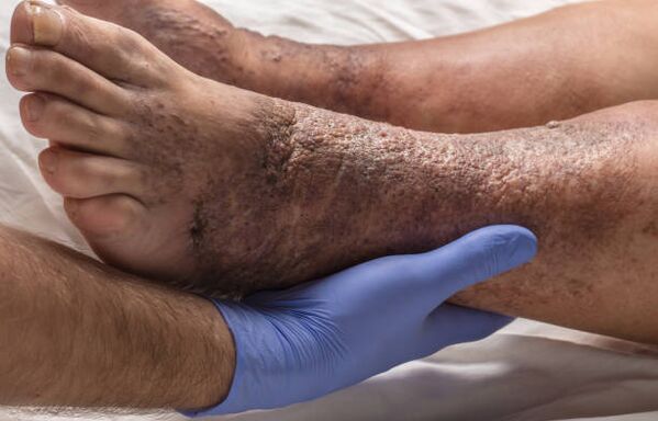 Complications after varicose veins