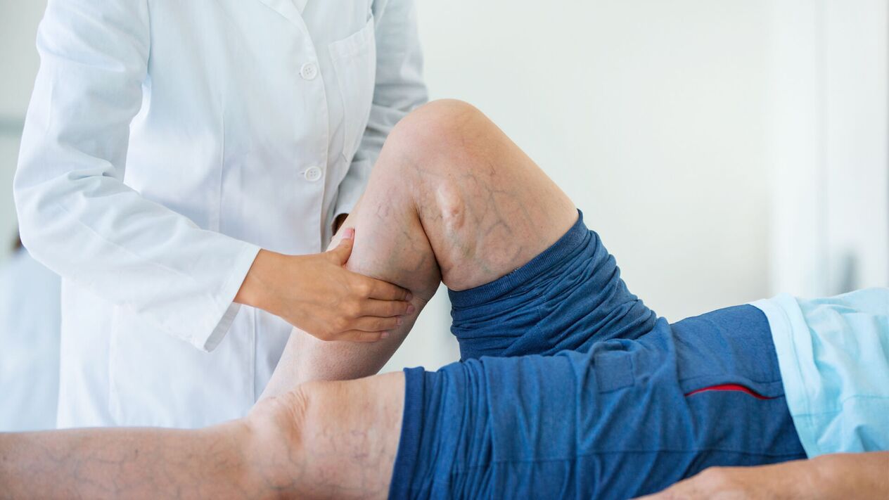 How do varicose veins develop on the legs