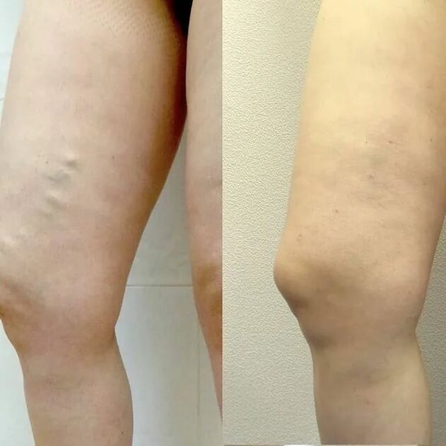 before and after treatment of varicose veins